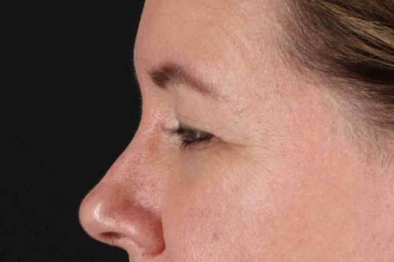 Brow Lift Before & After Patient #1566