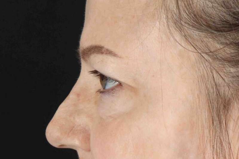 Brow Lift Before & After Patient #1577