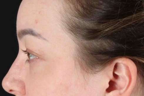 Brow Lift Before & After Patient #1588