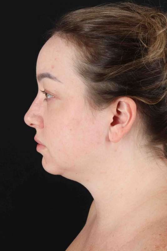 Face Lift Before & After Patient #1654