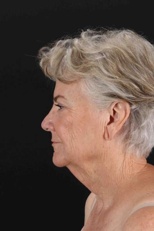 Neck Lift Before & After Patient #1676
