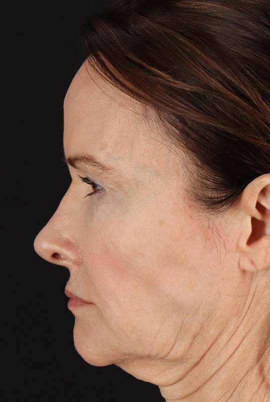 Neck Lift Before & After Patient #1698