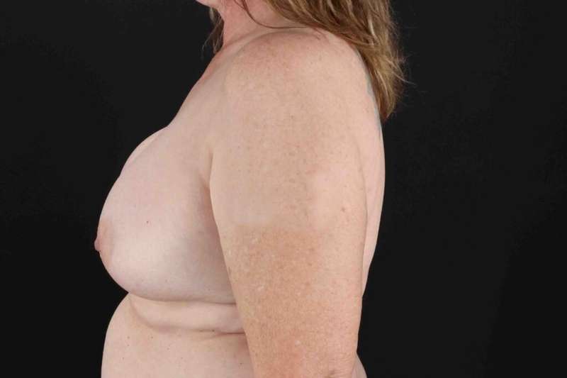 Breast Implant Removal Before & After Patient #872