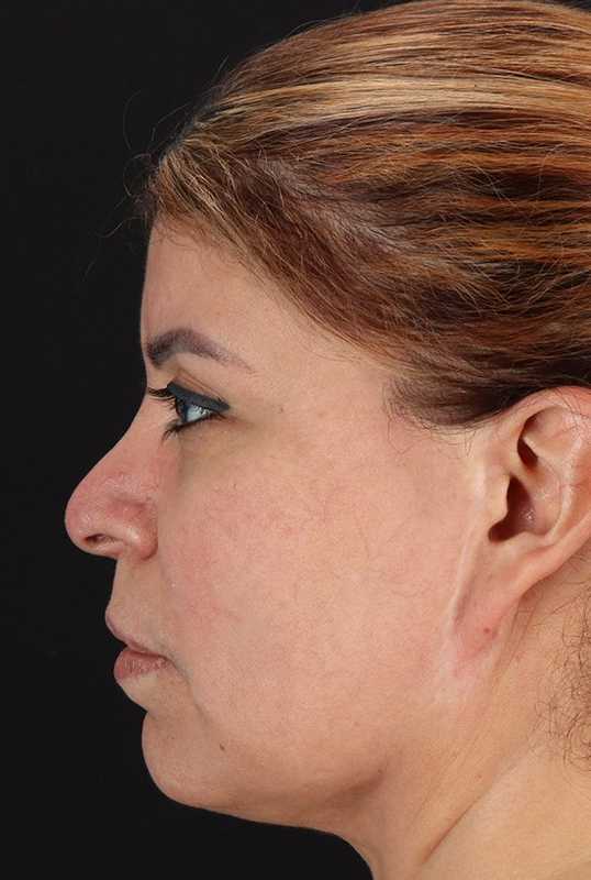 Neck Lift Before & After Patient #1709