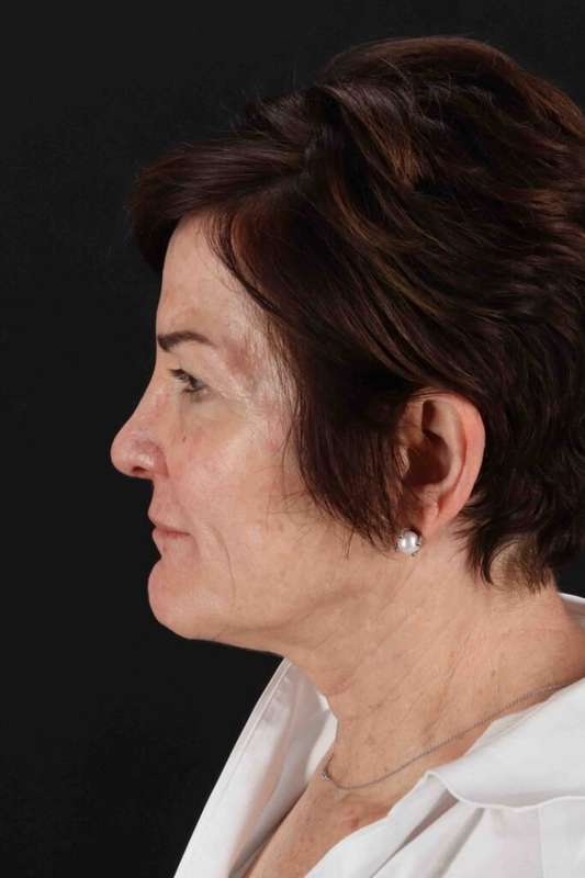 Neck Lift Before & After Patient #1731