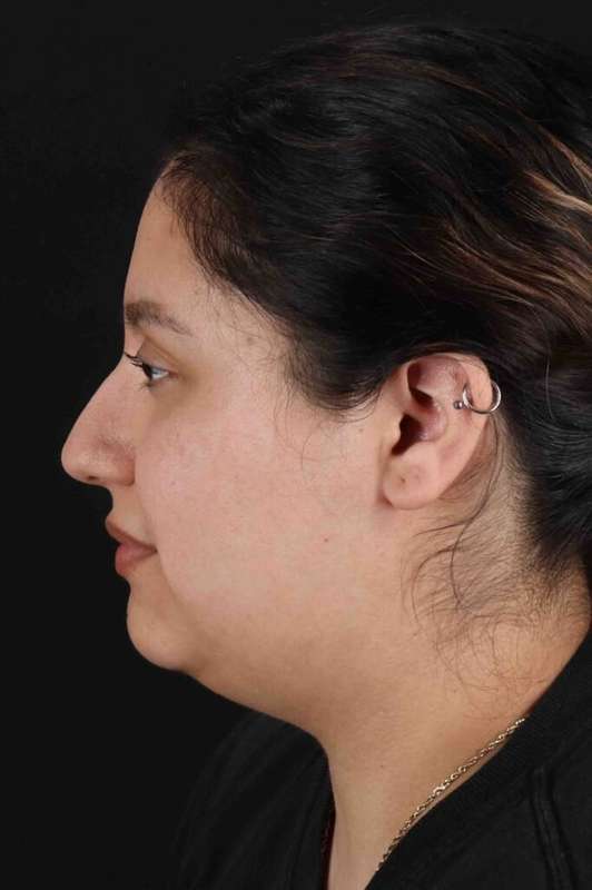 Neck Liposuction Before & After Patient #1753