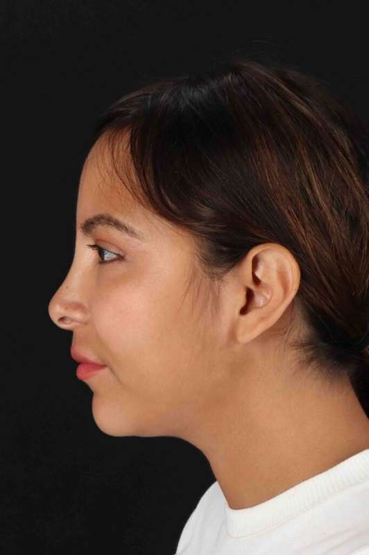 Neck Liposuction Before & After Patient #1764