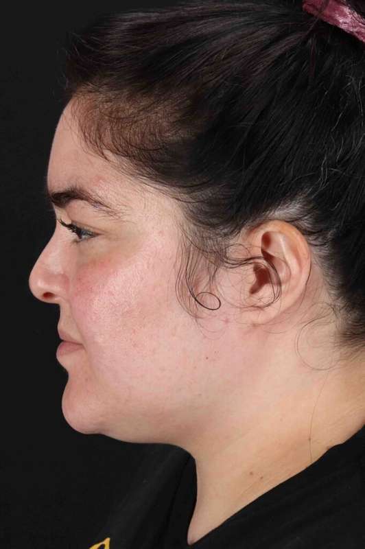 Neck Liposuction Before & After Patient #1775
