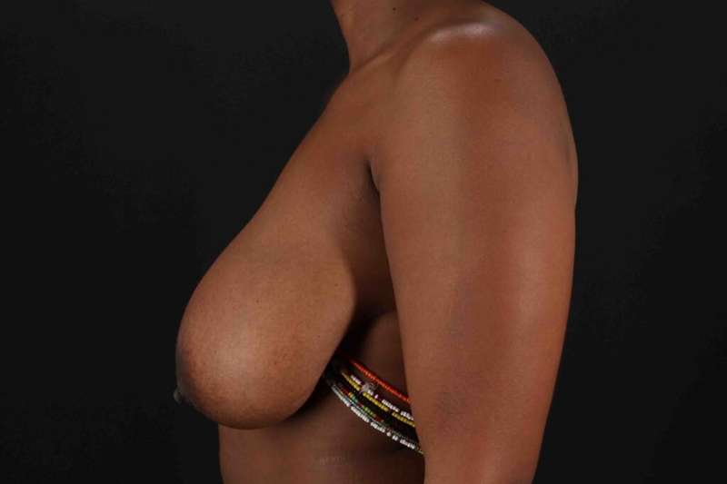 Breast Reduction with Lift Before & After Patient #883
