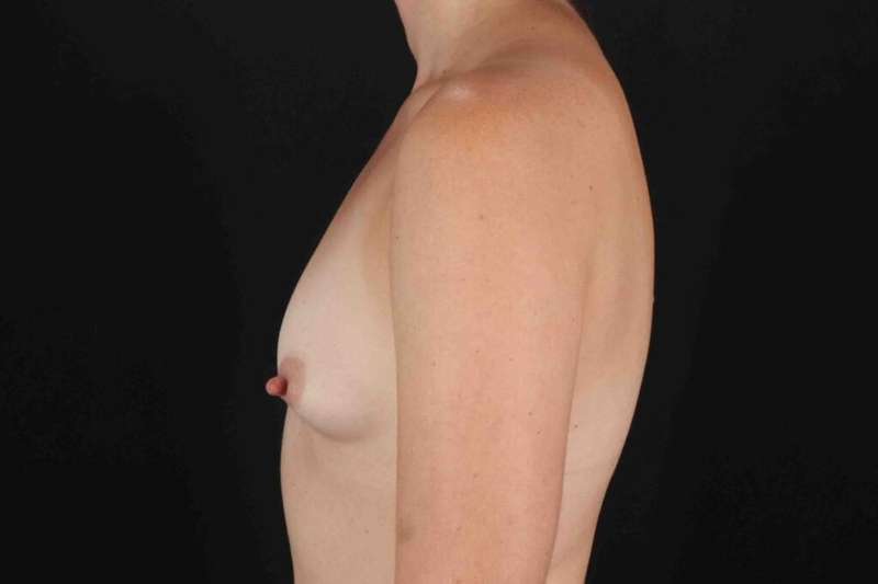 Breast Augmentation with Fat Transfer Before & After Patient #784