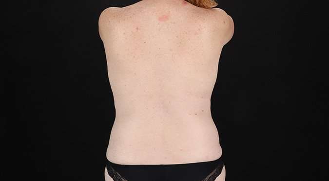 Tummy Tuck Before & After Patient #1477