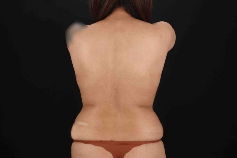 Tummy Tuck Before & After Patient #1528