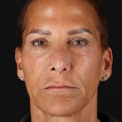CO2 Laser Before & After Patient #2878