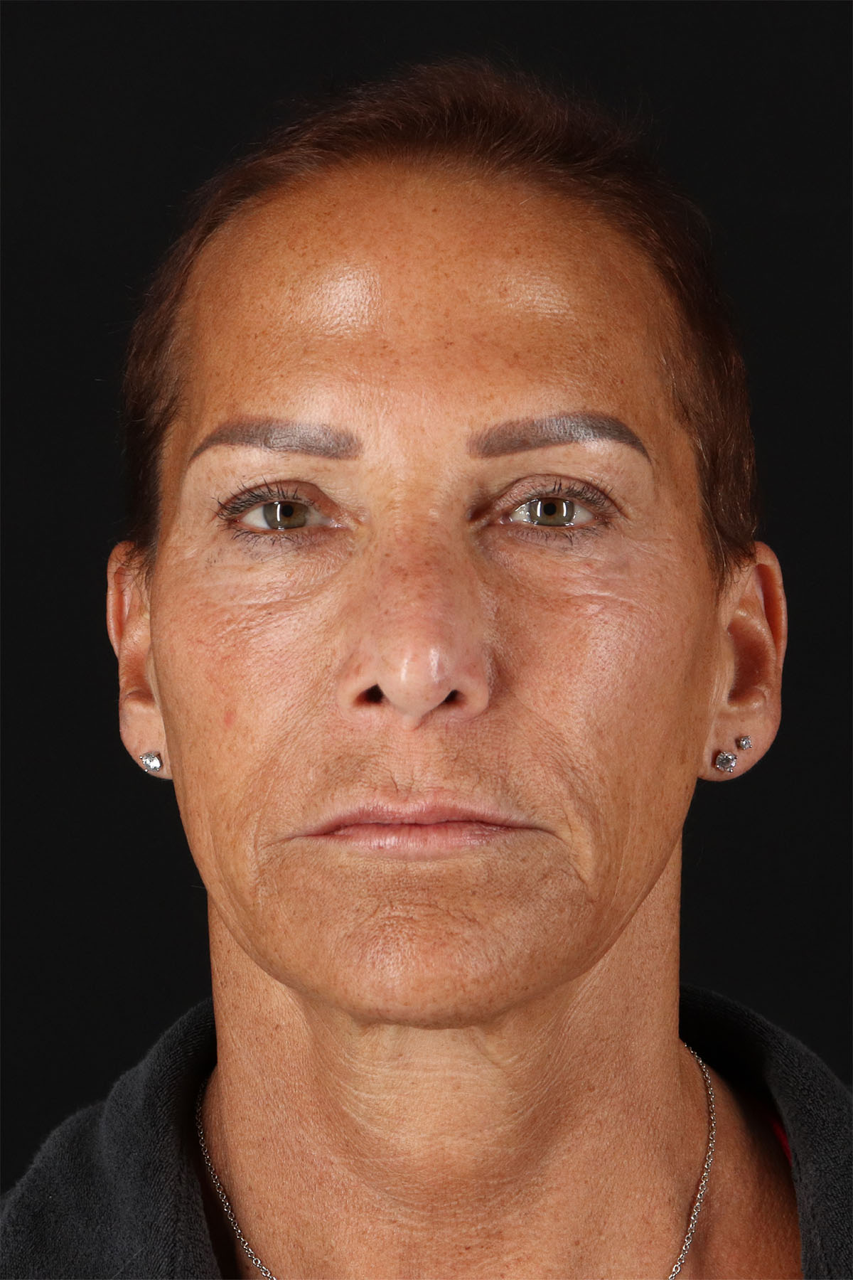CO2 Laser Before & After Patient #2878