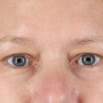 Eyelid Surgery Before & After Patient #2879