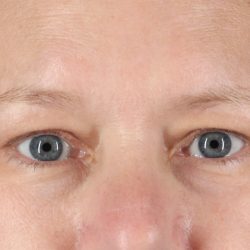 Eyelid Surgery Before & After Patient #2879