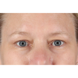 Eyelid Surgery Before & After Patient #2879