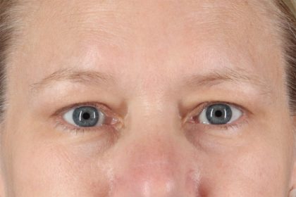 Eyelid Surgery Before & After Patient #2879