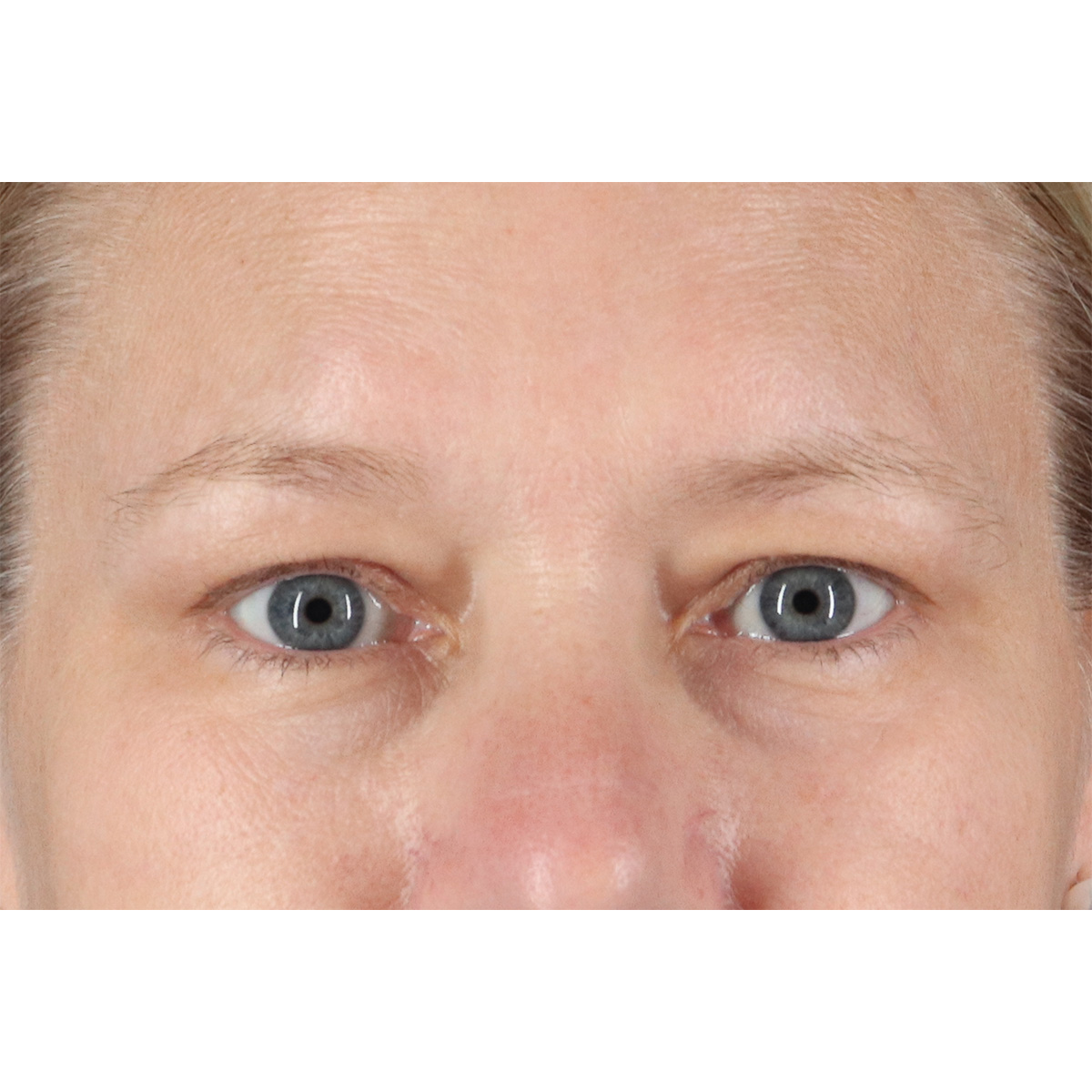 Eyelid Surgery Before & After Patient #2879