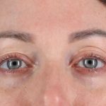 Eyelid Surgery Before & After Patient #2882