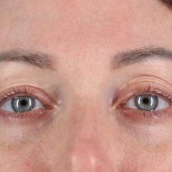 Eyelid Surgery Before & After Patient #2882