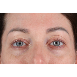Eyelid Surgery Before & After Patient #2882