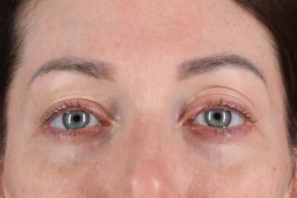 Eyelid Surgery Before & After Patient #2882