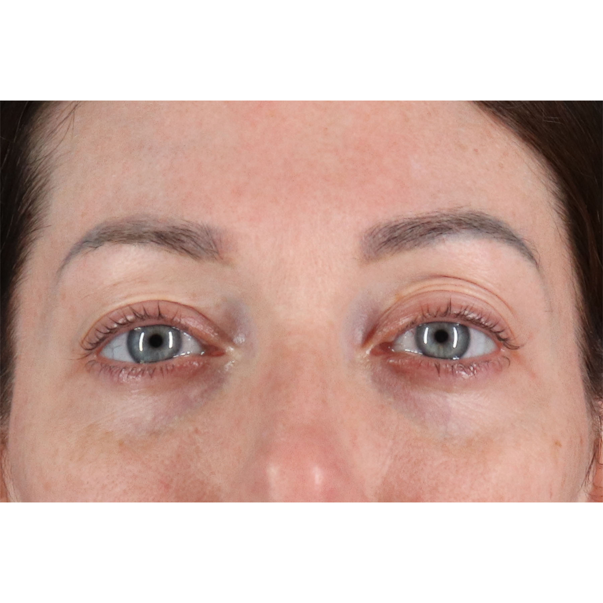 Eyelid Surgery Before & After Patient #2882
