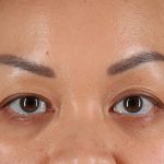Eyelid Surgery Before & After Patient #2883