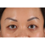 Eyelid Surgery Before & After Patient #2883