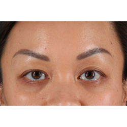 Eyelid Surgery Before & After Patient #2883