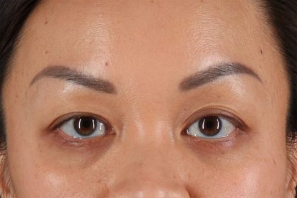 Eyelid Surgery Before & After Patient #2883