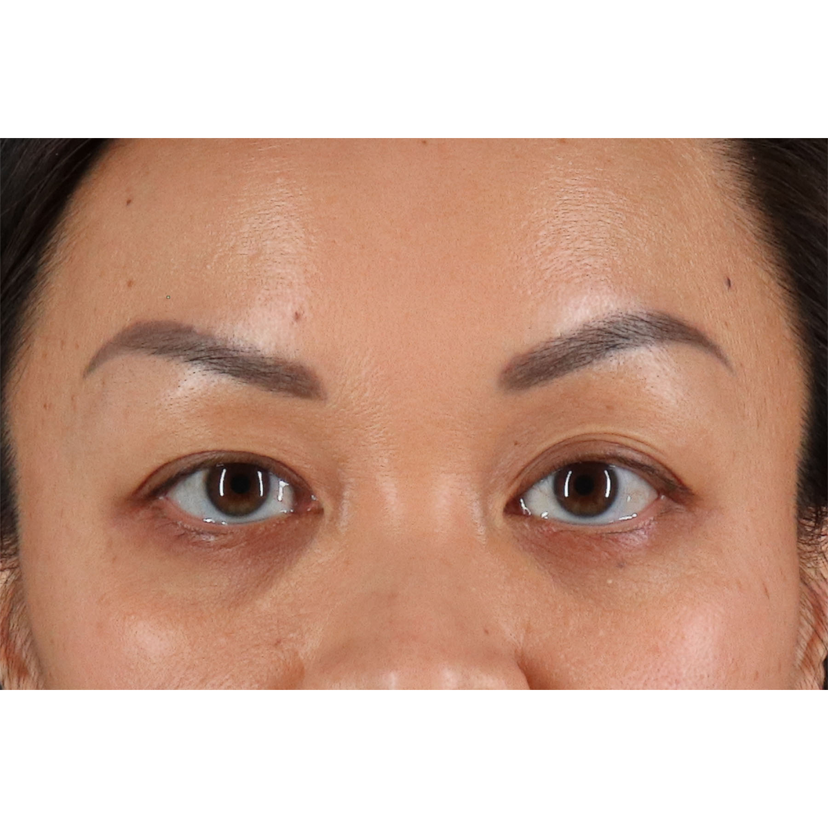 Eyelid Surgery Before & After Patient #2883