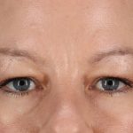 Eyelid Surgery Before & After Patient #2885