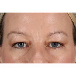 Eyelid Surgery Before & After Patient #2885