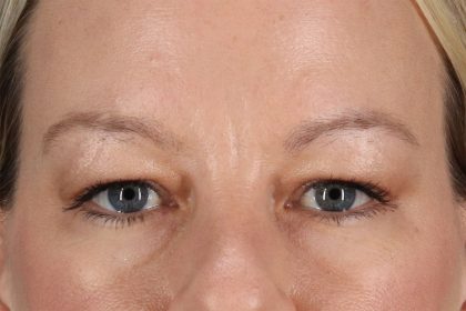 Eyelid Surgery Before & After Patient #2885