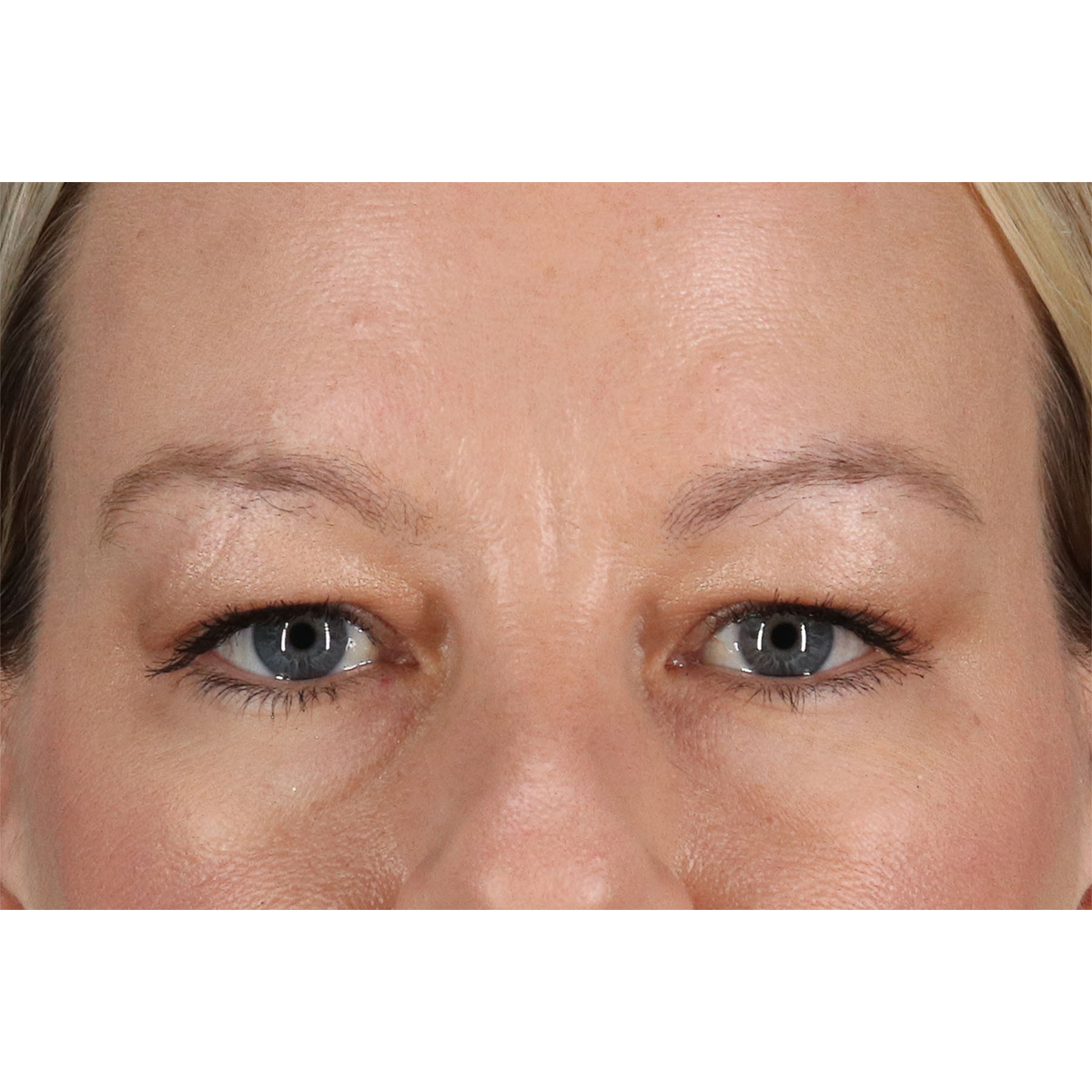 Eyelid Surgery Before & After Patient #2885