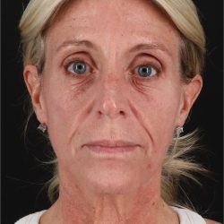 Face Lift Before & After Patient #2886