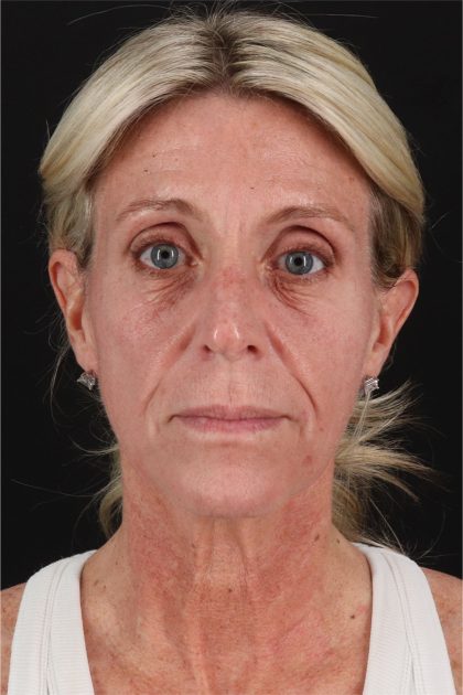 Face Lift Before & After Patient #2886