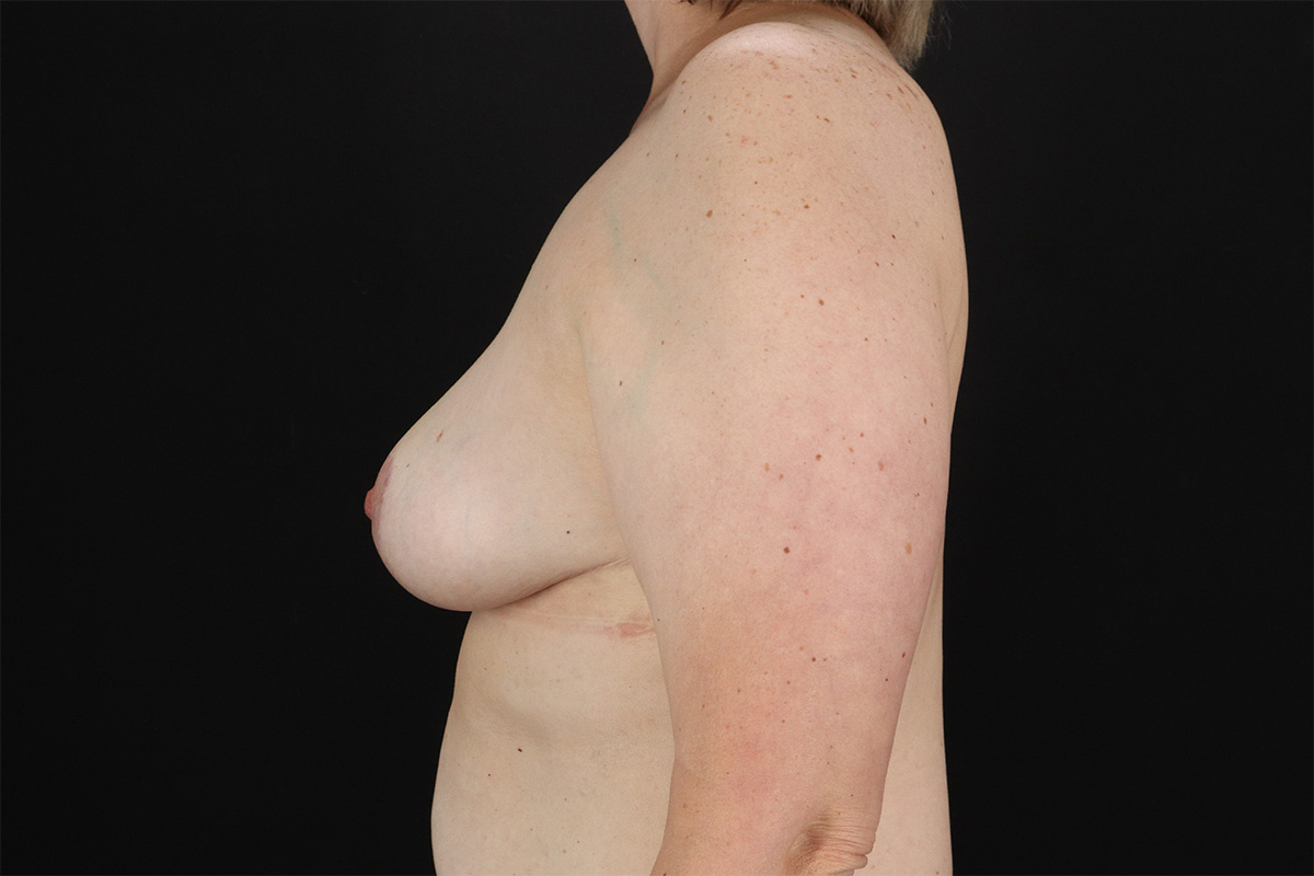 Breast Reduction with Lift Before & After Patient #2877