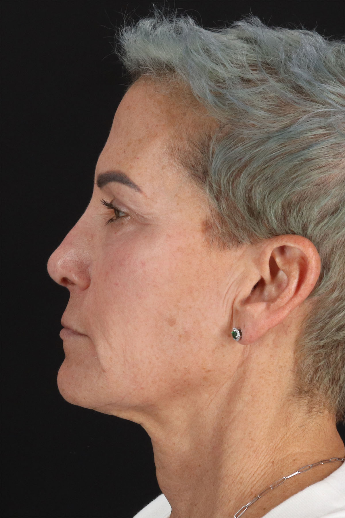 CO2 Laser Before & After Patient #2878