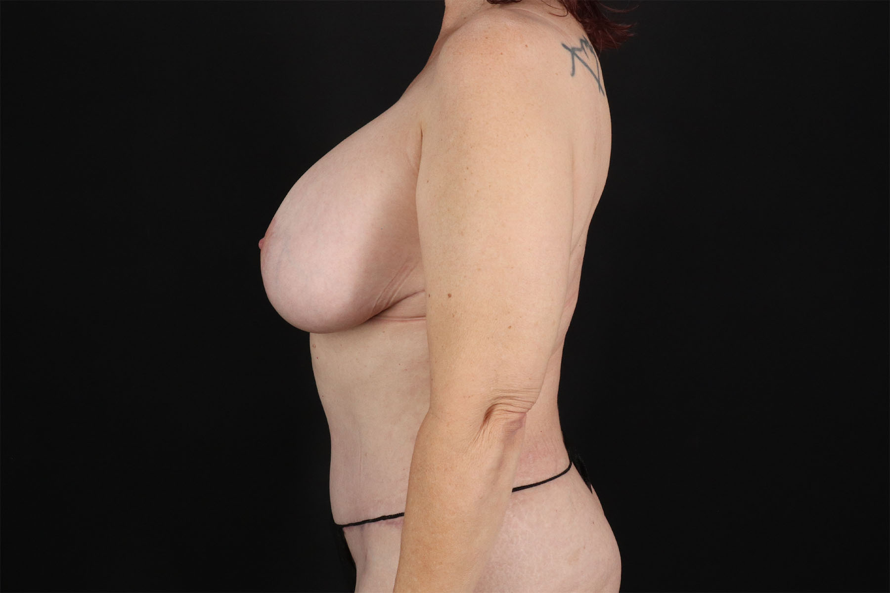 Mommy Makeover Before & After Patient #2881