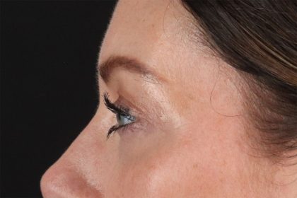 Eyelid Surgery Before & After Patient #2882