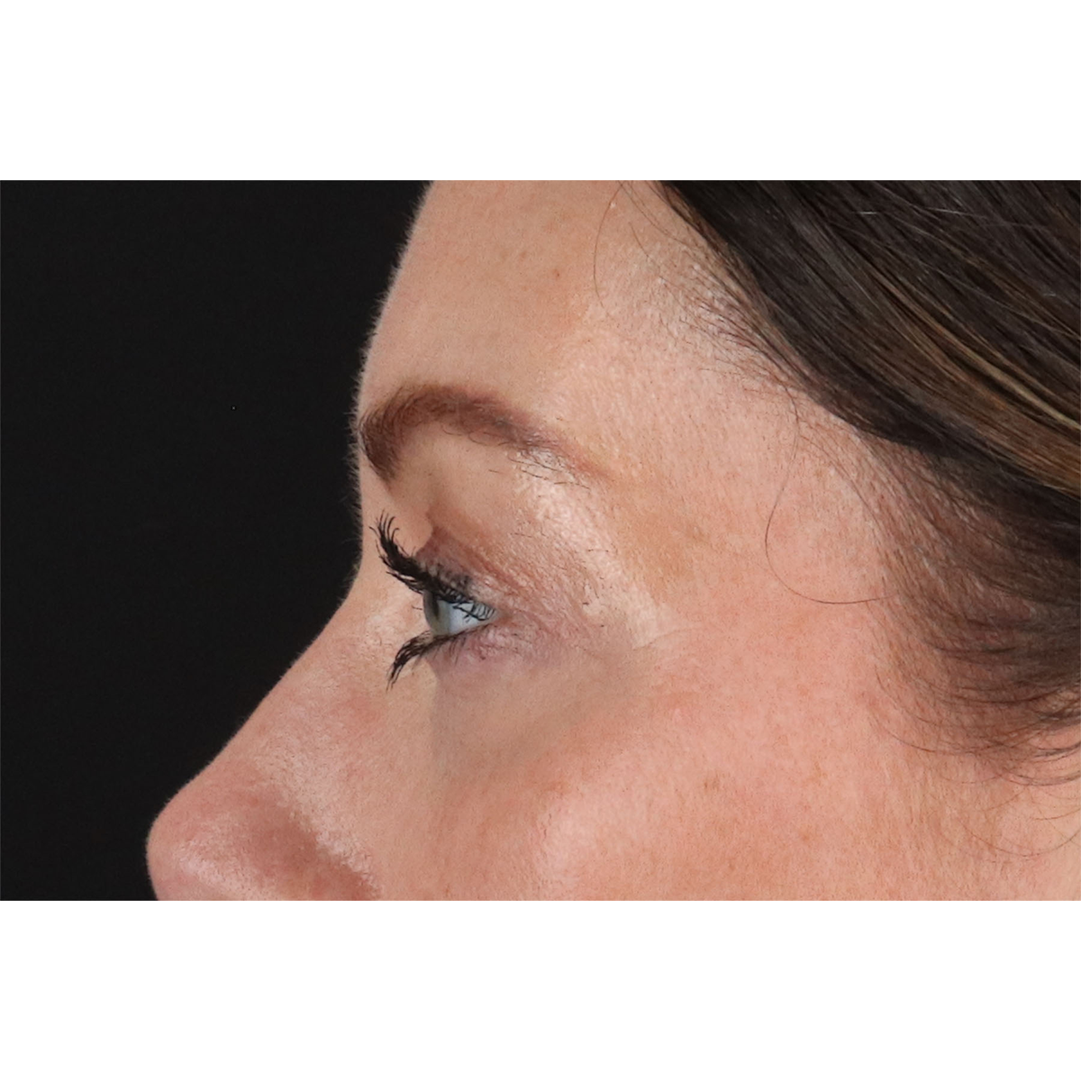 Eyelid Surgery Before & After Patient #2882