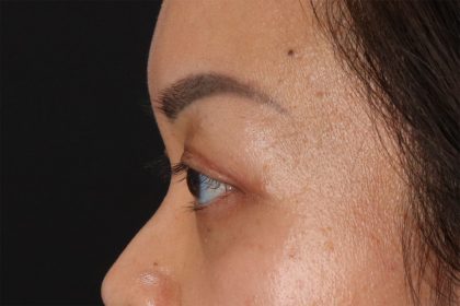 Eyelid Surgery Before & After Patient #2883