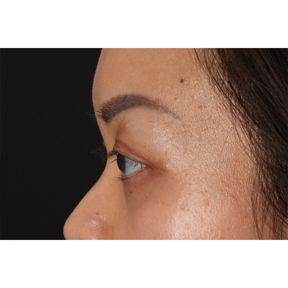 Eyelid Surgery Before & After Patient #2883