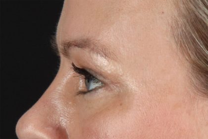 Eyelid Surgery Before & After Patient #2885