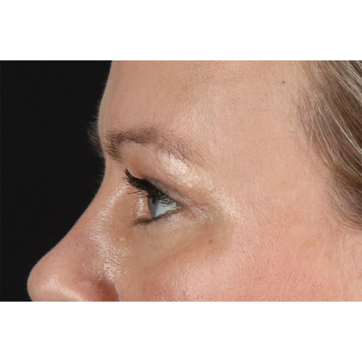 Eyelid Surgery Before & After Patient #2885