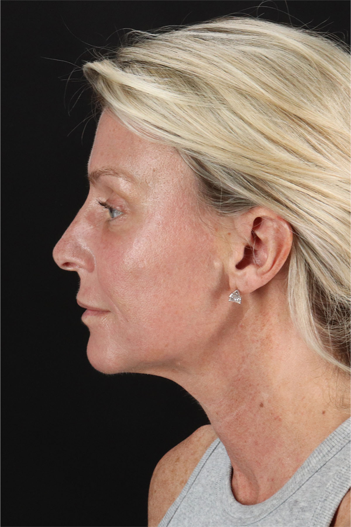 Structural Fat Grafting Before & After Patient #3650