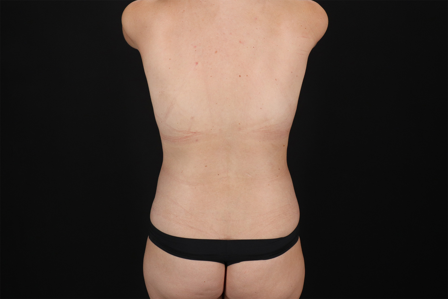 Mommy Makeover Before & After Patient #2880